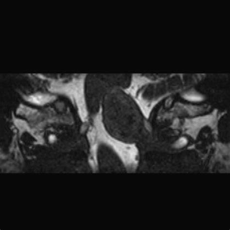 Schwannoma Foramen Magnum Image