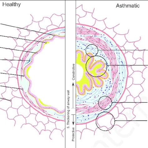 Airway smooth muscle in (severe) asthma and a non-asthmatic control ...