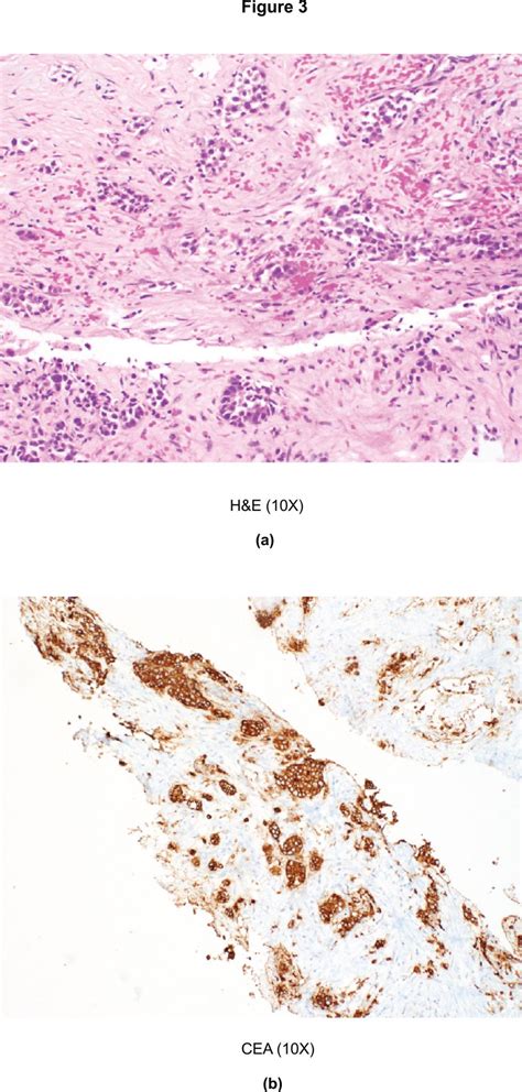 Medullary Thyroid Carcinoma Presenting As Metastatic Disease To The