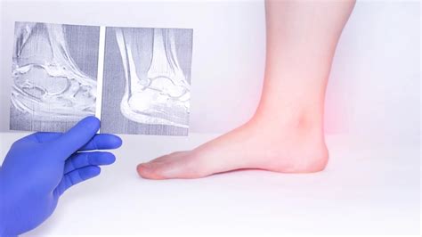 Ankle instability: everything you need to know about it! | Dr Bijan 4 Feet