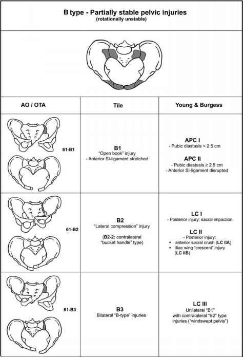 Classification of Pelvic Ring Injuries - Acetabular Fractures