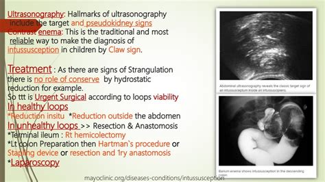 Intestinal Bowel Strangulation