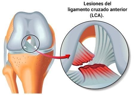 LESIONES DE RODILLA Mind Map