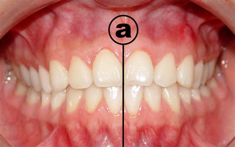 Ocea Función Y Estetica Orofacial Las Seis Llaves De La Oclusion