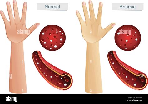 Human Anatomy Vector Of Anemia Illustration Stock Vector Image Art