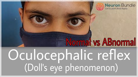 Dollseyereflex Vestibulo Ocular Reflex Normal And Abnormal Made