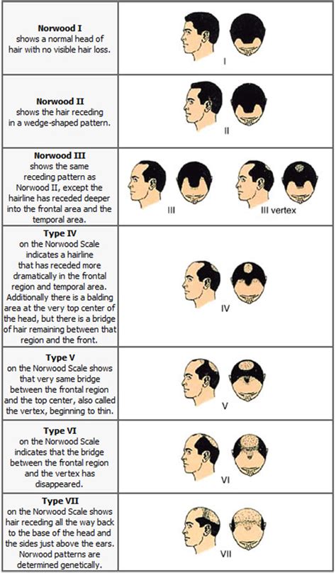 Cure Against Baldness Norwood Hamilton Scale Of Male Pattern Baldness