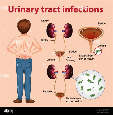 Ilustración Informativa De Infecciones Del Tracto Urinario Imagen Vector De Stock Alamy