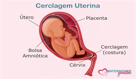 Cerclagem Uterina Procedimento Evita Abortos E Partos Prematuros