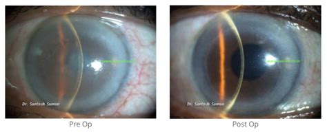 Dsek Cornea