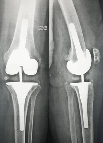 Chirurgie prothèse totale de genou PTG Paris Tunisie