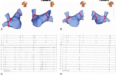 The Electroanatomical Map Reconstruction Of The Left Atrium And