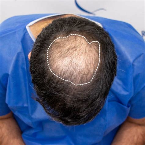 Crown Hair Transplant | The Sharma Clinic