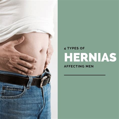 4 Types Of Hernias Affecting Men Nyc Soho Men S Health