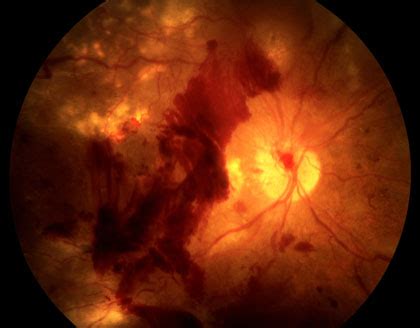 Diabetic Retinopathy Retina Macula Institute