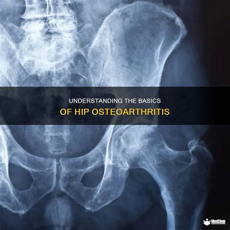 Understanding The Basics Of Hip Osteoarthritis | MedShun