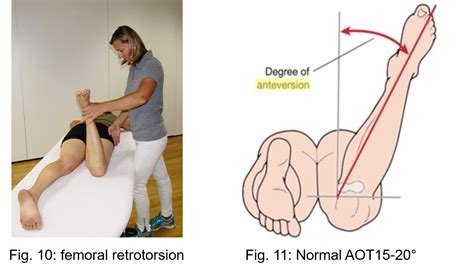 Femoral Anteversiyon