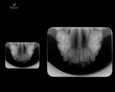 Radiografia Oclusal Precisão Radiologia Odontológica Digital