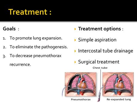 Pneumothorax Pptx Definition Types Clinical Features Diagnosis