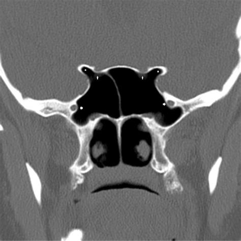 Postnasal Discharge From Left Sphenoethmoidal Recess Notes Endoscopic