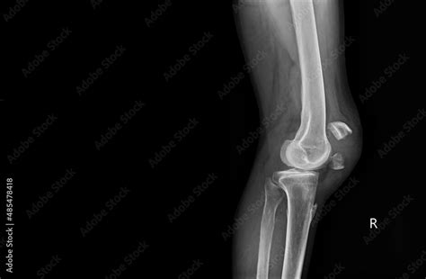 A film x-ray of left knee lateral view shown fracture of knee cap ...