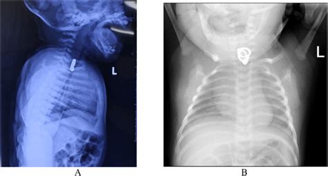 A And B Chest X Ray Show The Foreign Body At The Level Of The 7th