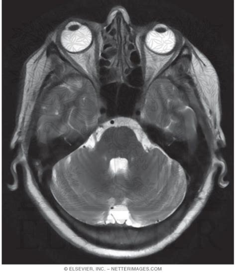 T2 Axial Mri Through The Cerebellum Temporal Lobes And Eye