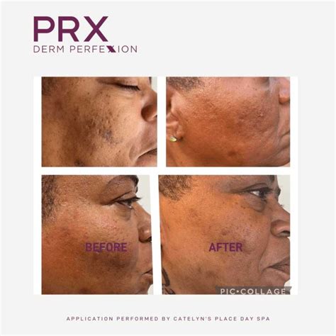 Prx Derm Perfexion Interlocks Medspa