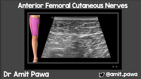 Anterior Femoral Cutaneous Nerve Block Youtube