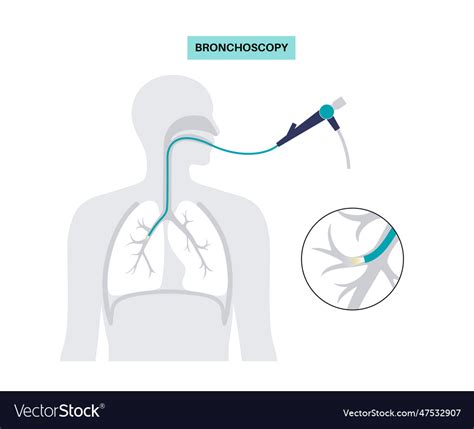 Bronchoscopy Procedure Concept Royalty Free Vector Image