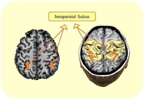 Intraparietal Sulcus Mri