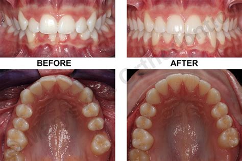 Smile Gallery — Marysville Orthodontics Braces Invisalign Smokey