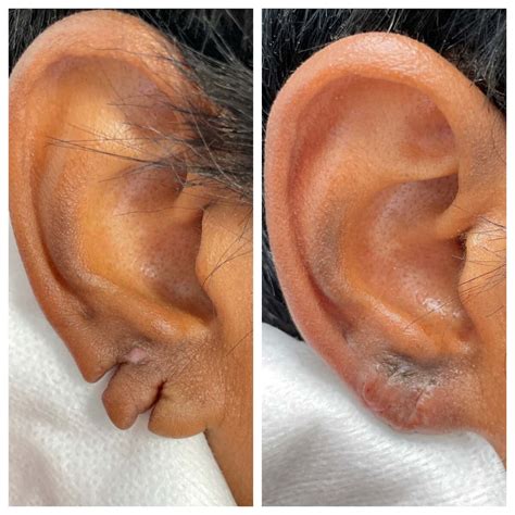 Otoplasty St Louis Ear Plastic Surgery St Louis Ear Reduction