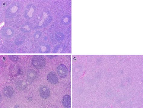 Imaging Of Castleman Disease Radiographics