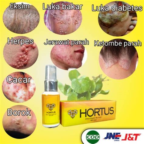 Jual OBAT SEGALA PENYAKIT KULIT Obat Luka Diabetes Herper Cacar Eksim