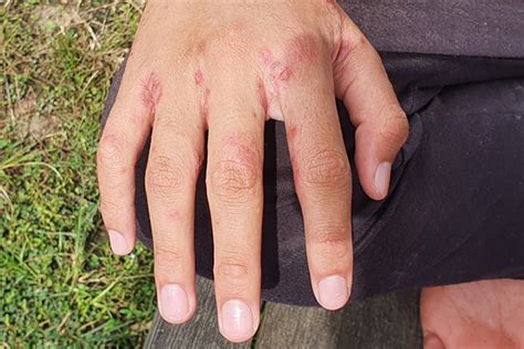 How To Identify Scabies A Contagious And Uncomfortable Skin Condition