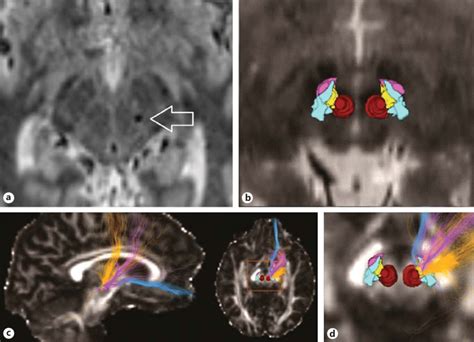 A Stereotactic Placement Of A Dbs Electrode In Raprl In A Postoperative