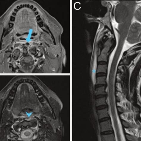 Tomodensitométrie native du rachis cervical A coupe sagittale oedème