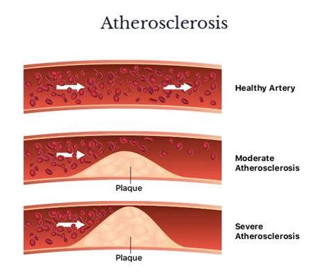 Heart Disease Symptoms Treatment And Prevention