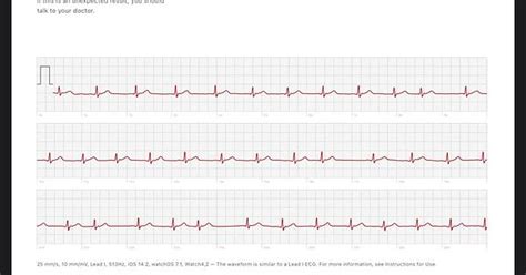 This Ecg Shows Sign Of Afib Is This Afib Imgur