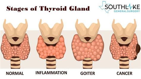 Thyroid Cancer Stages Artofit