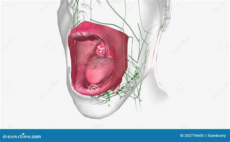 Strep Throat Is Caused By Infection With A Bacterium Known As