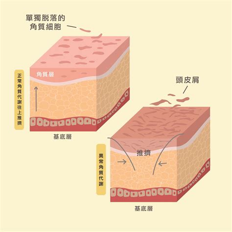 頭皮保養5課題 改善頭皮屑∣去角質∣保濕∣清潔∣強健髮根，一次搞定