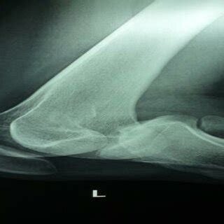 Dislocated knee joint. | Download Scientific Diagram