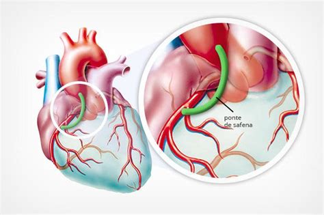 Ponte De Safena Sp Cirurgi O Card Aco Sp