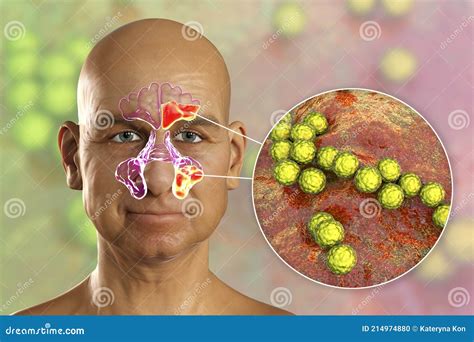 Inflammation Of Frontal Maxillary And Ethmoid Sinuses And Close Up