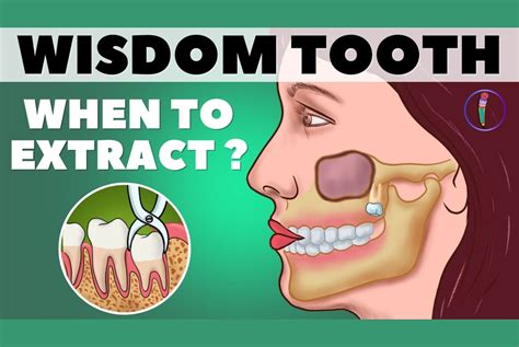 Wisdom Teeth Removal Know When To Pull Them Out Medinaz Blog