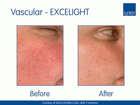 Thread Vein Removal Rosacea Ipl Revive Skin And Laser