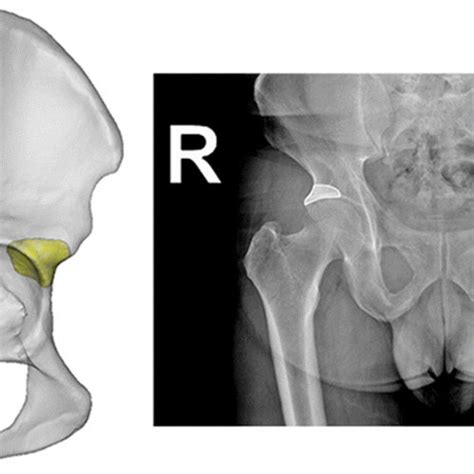 X-ray of the anterosuperior bone stock of the acetabulum | Download ...