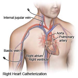 Right Heart Catheterization Discharge Care What You Need To Know